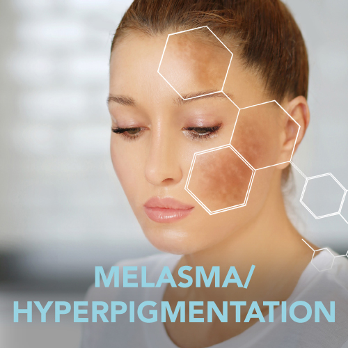 Melasma/Hyperpigmentation
