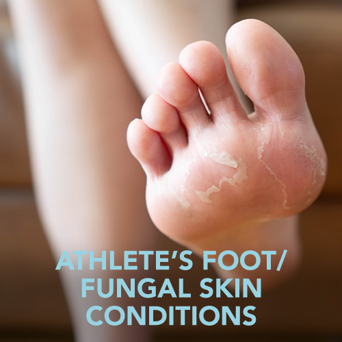 Athlete’s Foot/Fungal Skin Conditions Teens