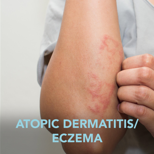 Atopic Dermatitis/Eczema Teens