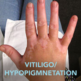 VITILIGO/ HYPOPIGMNETATION